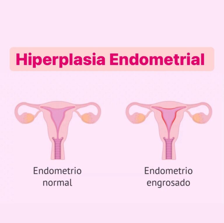 Hiperplasia Endometrial Dra Lucy Abdala 